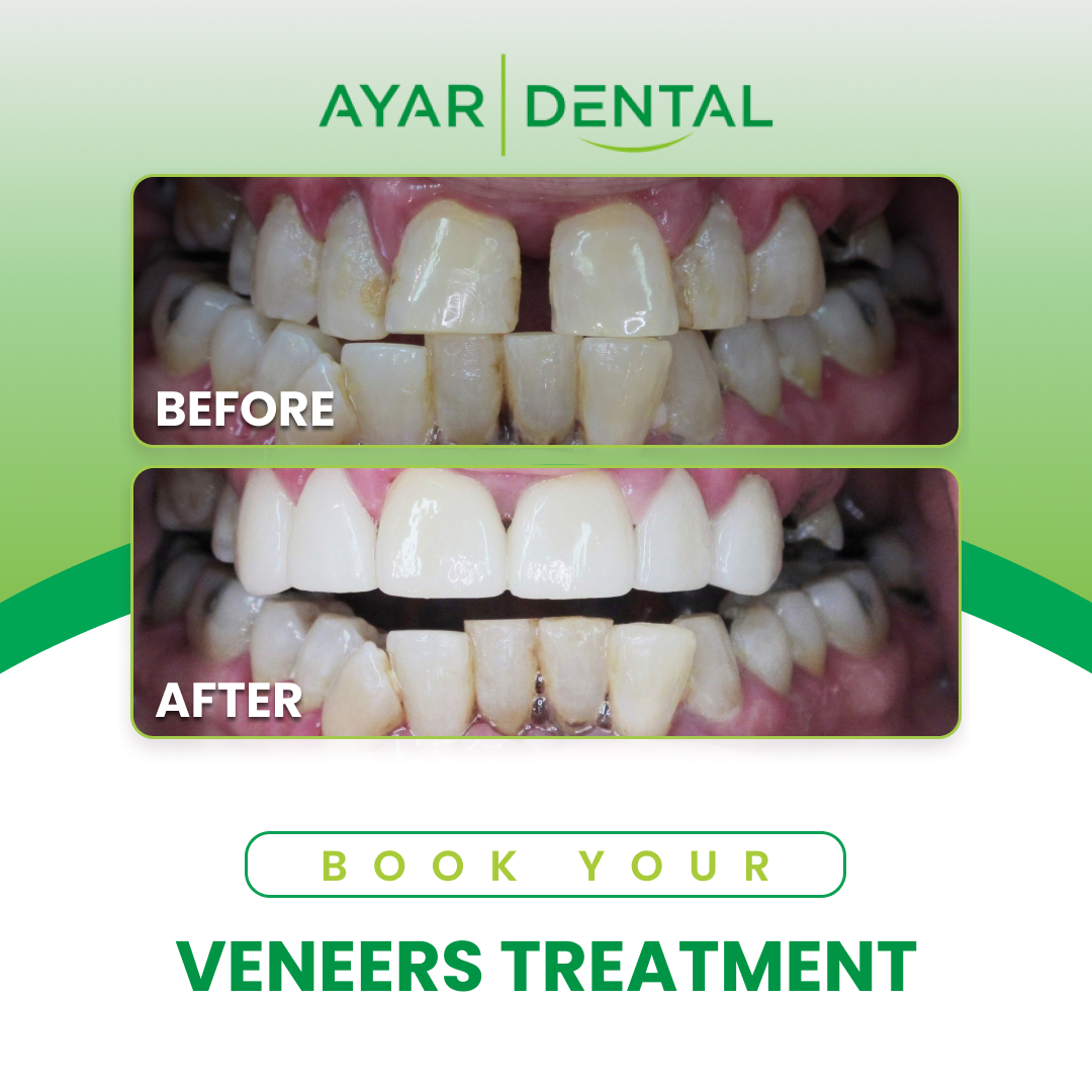 7-5 Porcelain Veneers