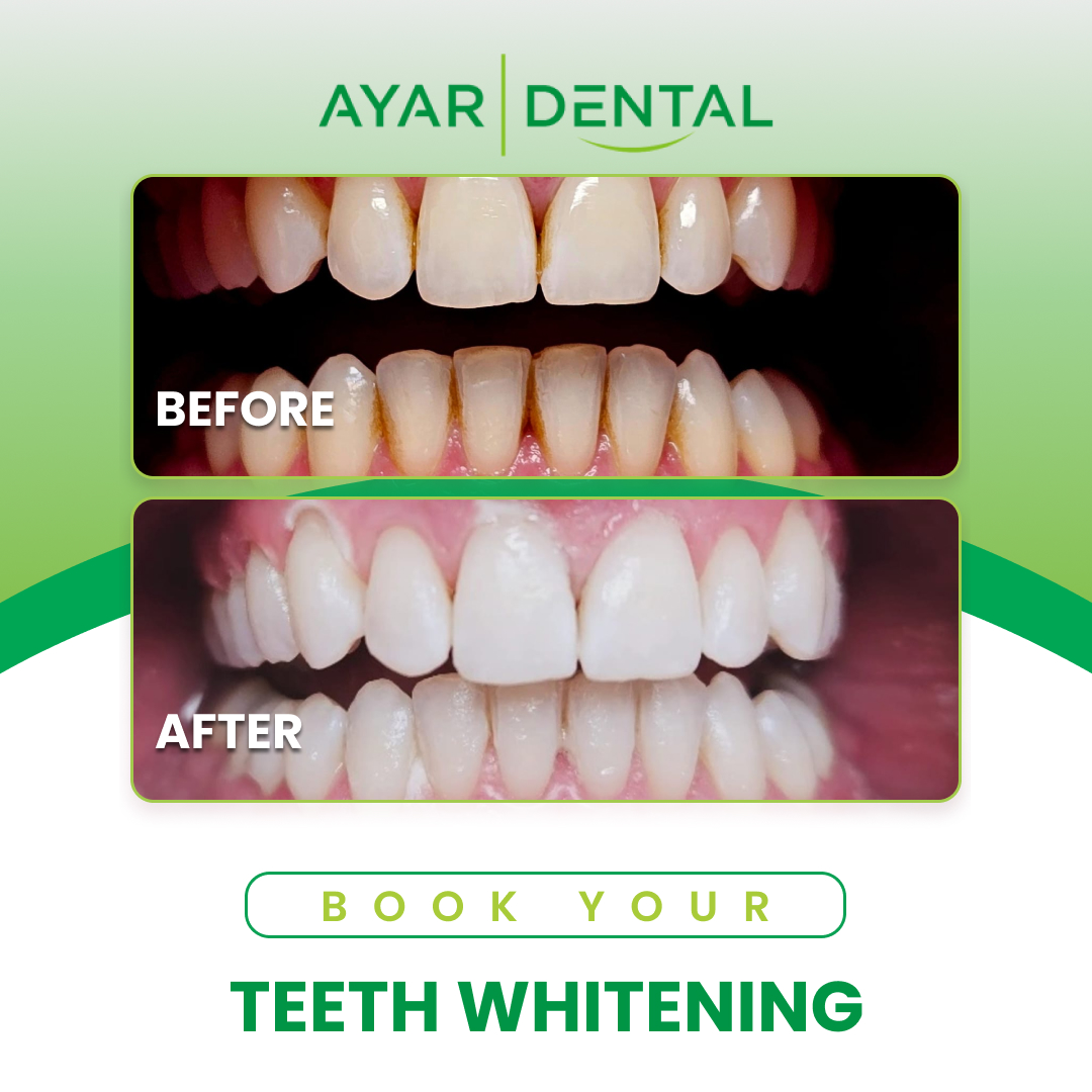 9-2 (1) Whitening Considerations