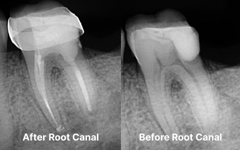 Frame-1 Root Canal Therapy - Everything You Need To Know