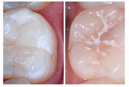 image1-1 Fissures Sealants & Fluoride