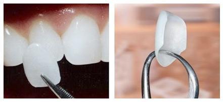 image5 Exploring Veneers - Composite vs Porcelain