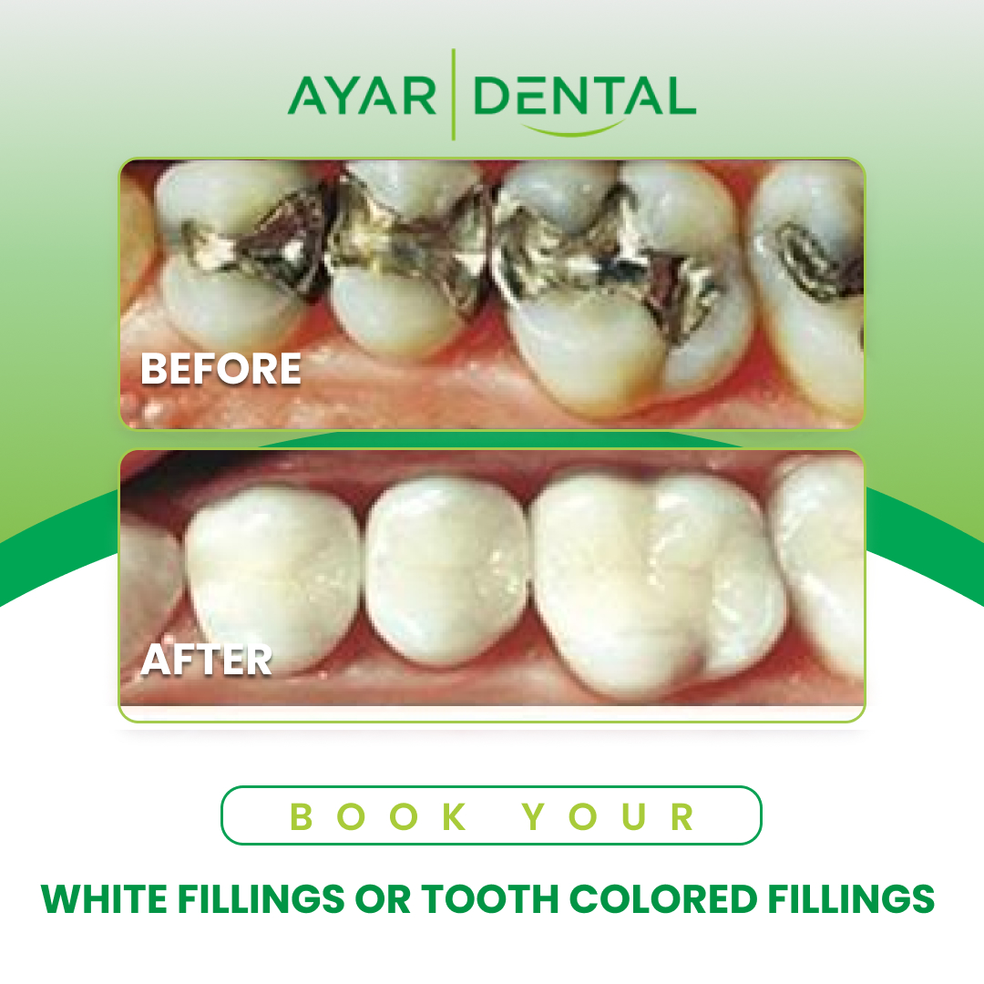 imgpsh_fullsize_anim-1 White Fillings