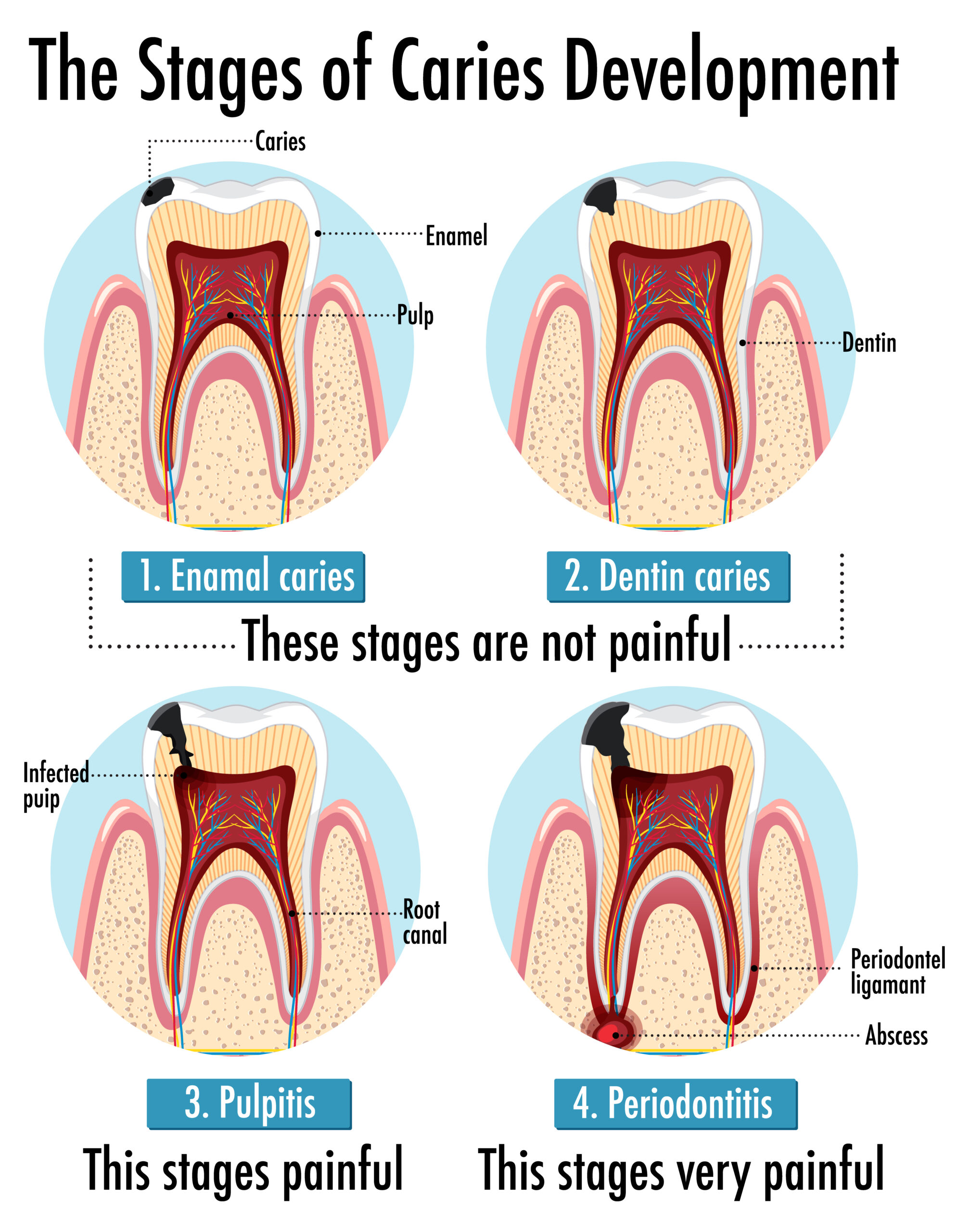 Infographic of human in the stages of caries development What to Expect During Root Canal Therapy
